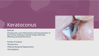 Keratoconus
Defined:
•Progressive, non-inflammatory thinning disorder of
the cornea, leading to altered shape adversely
affecting visual performance
Variety of ectasias
•Keratoconus
•Pellucid Marginal Degeneration
•Keratoglobus
 