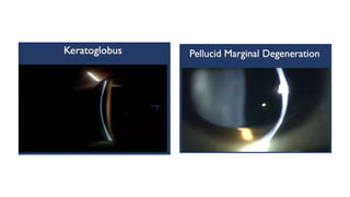 Diagnosis and management of Keratoconus cases