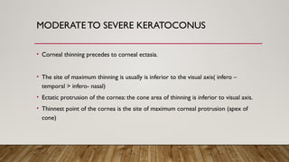 Comprehensive Overview of Keratoconus: Diagnosis, Pathogenesis, and ...