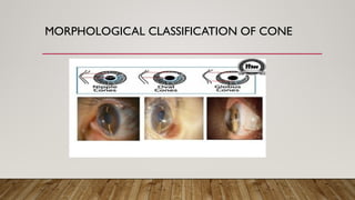Comprehensive Overview of Keratoconus: Diagnosis, Pathogenesis, and ...