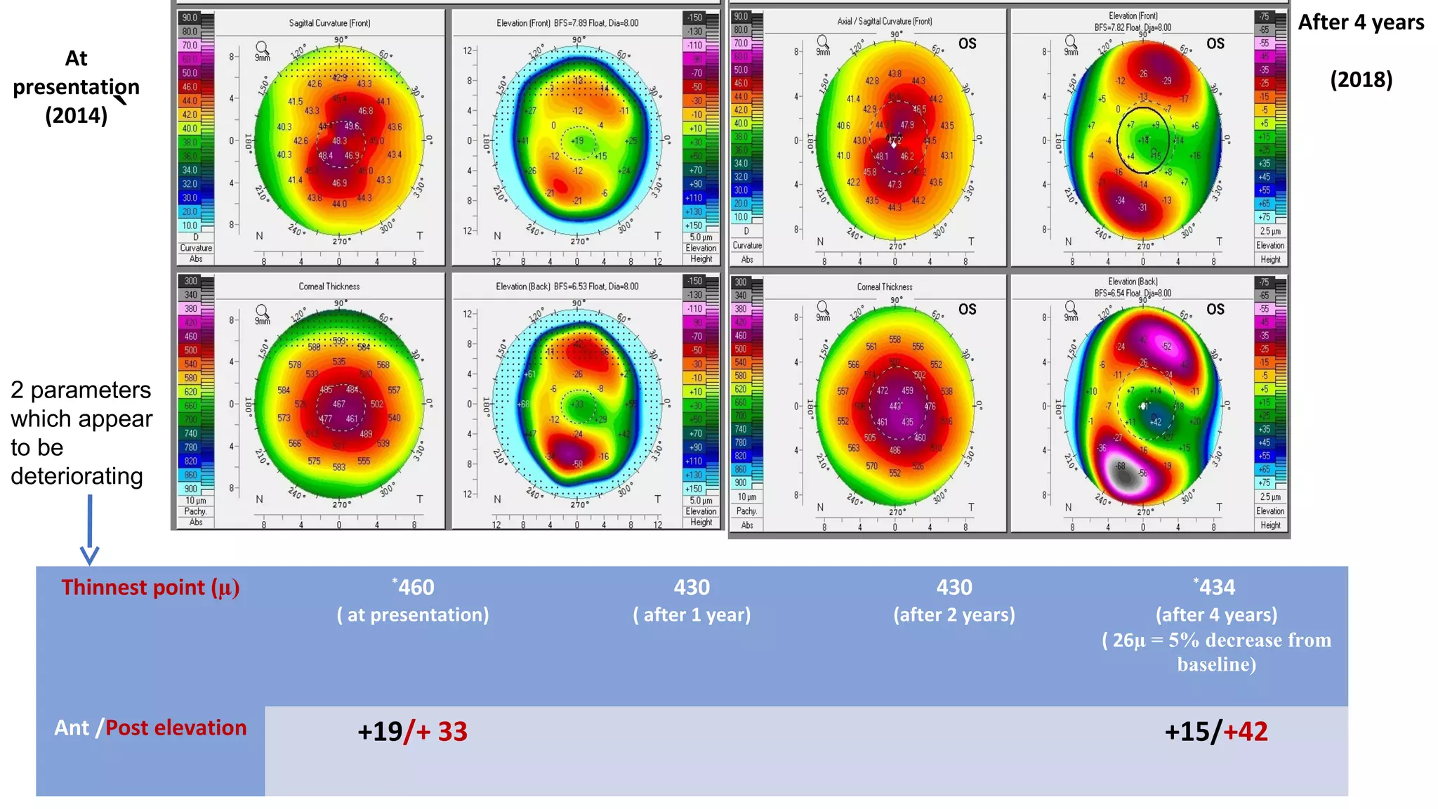 `
At
presentation
(2014)
Thinnest point (µ) *
460
( at presentation)
430
( after 1 year)
430
(after 2 years)
*
434
(after 4 years)
( 26µ = 5% decrease from
baseline)
Ant /Post elevation +19/+ 33 +15/+42
After 4 years
(2018)
2 parameters
which appear
to be
deteriorating
 