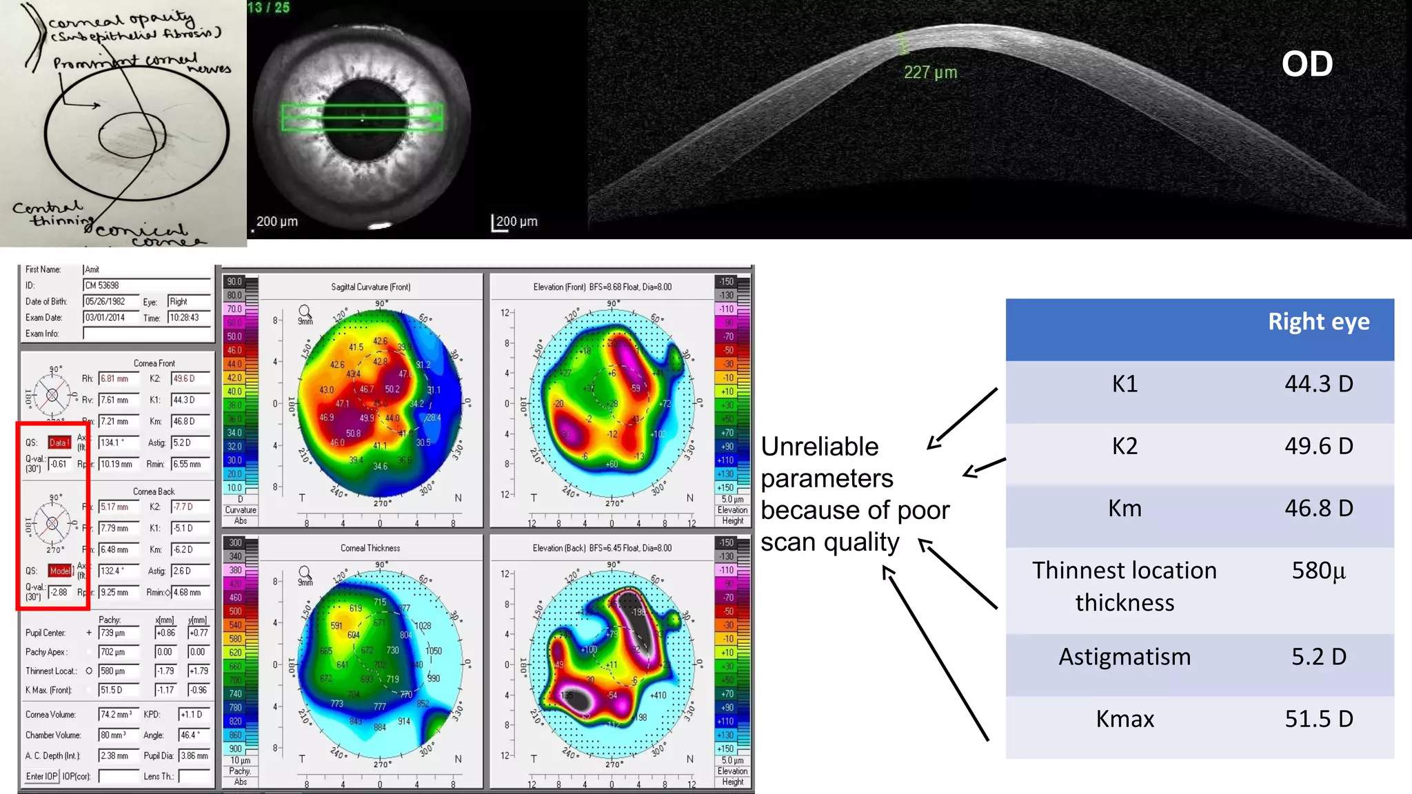 OD
OS
Right eye
K1 44.3 D
K2 49.6 D
Km 46.8 D
Thinnest location
thickness
580µ
Astigmatism 5.2 D
Kmax 51.5 D
OD
Unreliable
parameters
because of poor
scan quality
 