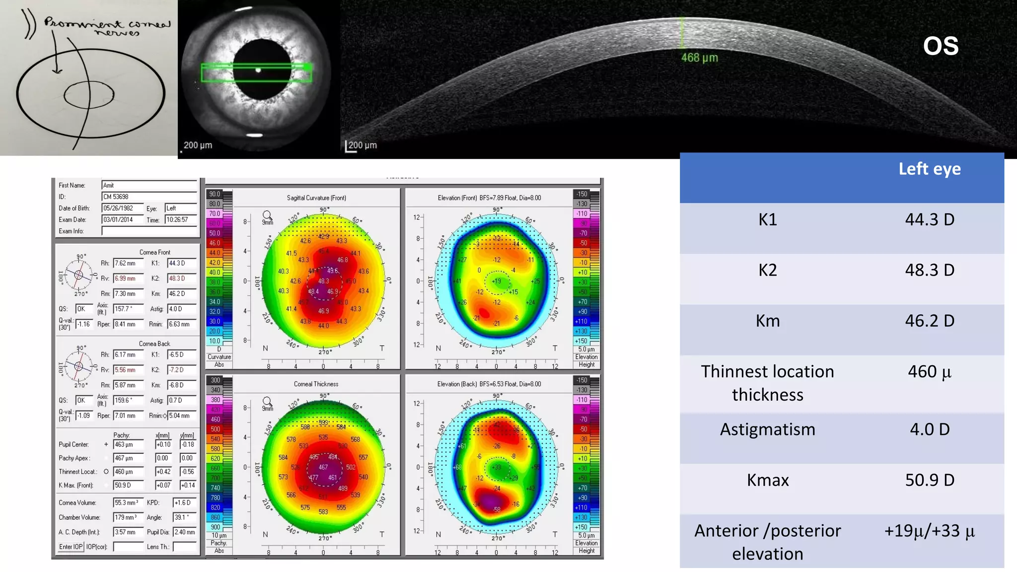 OD OS
On presentation
Left eye
K1 44.3 D
K2 48.3 D
Km 46.2 D
Thinnest location
thickness
460 µ
Astigmatism 4.0 D
Kmax 50.9 D
Anterior /posterior
elevation
+19µ/+33 µ
OS
 