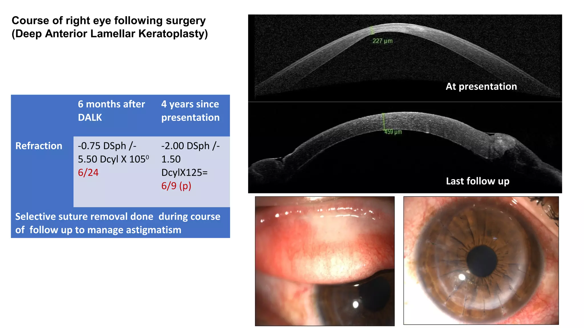 At Presentation
Post Op
4 years since DALK
At presentation
Last follow up
6 months after
DALK
4 years since
presentation
Refraction -0.75 DSph /-
5.50 Dcyl X 1050
6/24
-2.00 DSph /-
1.50
DcylX125=
6/9 (p)
Selective suture removal done during course
of follow up to manage astigmatism
Course of right eye following surgery
(Deep Anterior Lamellar Keratoplasty)
 