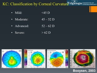 • Mild: <45 D
• Moderate: 45 – 52 D
• Advanced: 52 – 62 D
• Severe: > 62 D
Booysen, 2003
KC: Classification by Corneal Curvature
 