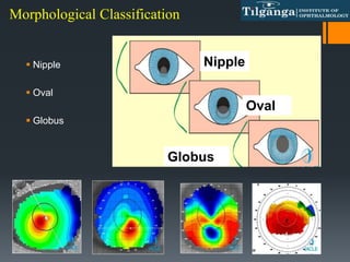  Nipple
 Oval
 Globus
Morphological Classification
Nipple
Oval
Globus
 