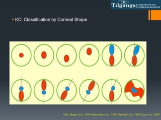  KC: Classification by Corneal Shape
After: Bogan et al., 1990, Rabinowitz et al., 1996, Rasheed et al., 1998, Levy et al., 2004
 