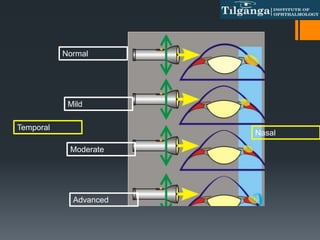 Normal
Mild
Moderate
Advanced
Temporal
Nasal
 