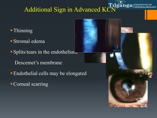 Additional Sign in Advanced KCN
Thinning
Stromal edema
Splits/tears in the endothelium/
Descemet’s membrane
Endothelial cells may be elongated
Corneal scarring
 