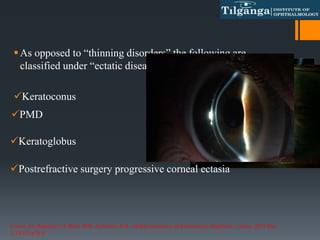 As opposed to “thinning disorders” the following are
classified under “ectatic diseases”
Keratoconus
PMD
Keratoglobus
Postrefractive surgery progressive corneal ectasia
Gomes JA, Rapuano CJ, Belin MW, Ambrósio Jr R. Global consensus on keratoconus diagnosis. Cornea. 2015 Dec
1;34(12):e38-9
 