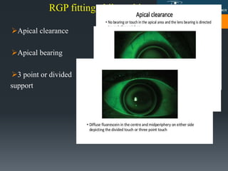 RGP fitting philosophies
Apical clearance
Apical bearing
3 point or divided
support
 