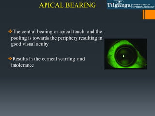 APICAL BEARING
The central bearing or apical touch and the
pooling is towards the periphery resulting in
good visual acuity
Results in the corneal scarring and
intolerance
 
