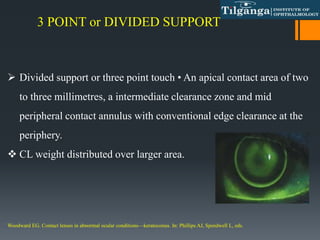 3 POINT or DIVIDED SUPPORT
 Divided support or three point touch • An apical contact area of two
to three millimetres, a intermediate clearance zone and mid
peripheral contact annulus with conventional edge clearance at the
periphery.
 CL weight distributed over larger area.
Woodward EG. Contact lenses in abnormal ocular conditions—keratoconus. In: Phillips AJ, Speedwell L, eds.
 