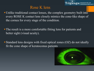 Rose K lens
Unlike traditional contact lenses, the complex geometry built into
every ROSE K contact lens closely mimics the cone-like shape of
the cornea for every stage of the condition.
The result is a more comfortable fitting lens for patients and
better sight (visual acuity).
Standard lens designs with fixed optical zones (OZ) do not ideally
fit the cone shape of keratoconus patients
 