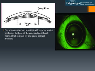  Fig shows a standard lens that will yield unwanted
pooling at the base of the cone and peripheral
bearing that can seal off and cause corneal
problems
 