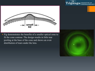  Fig demonstrates the benefits of a smaller optical zone to
fit the cone contour. The design results in little tear
pooling at the base of the cone and shows an even
distribution of tears under the lens.
 