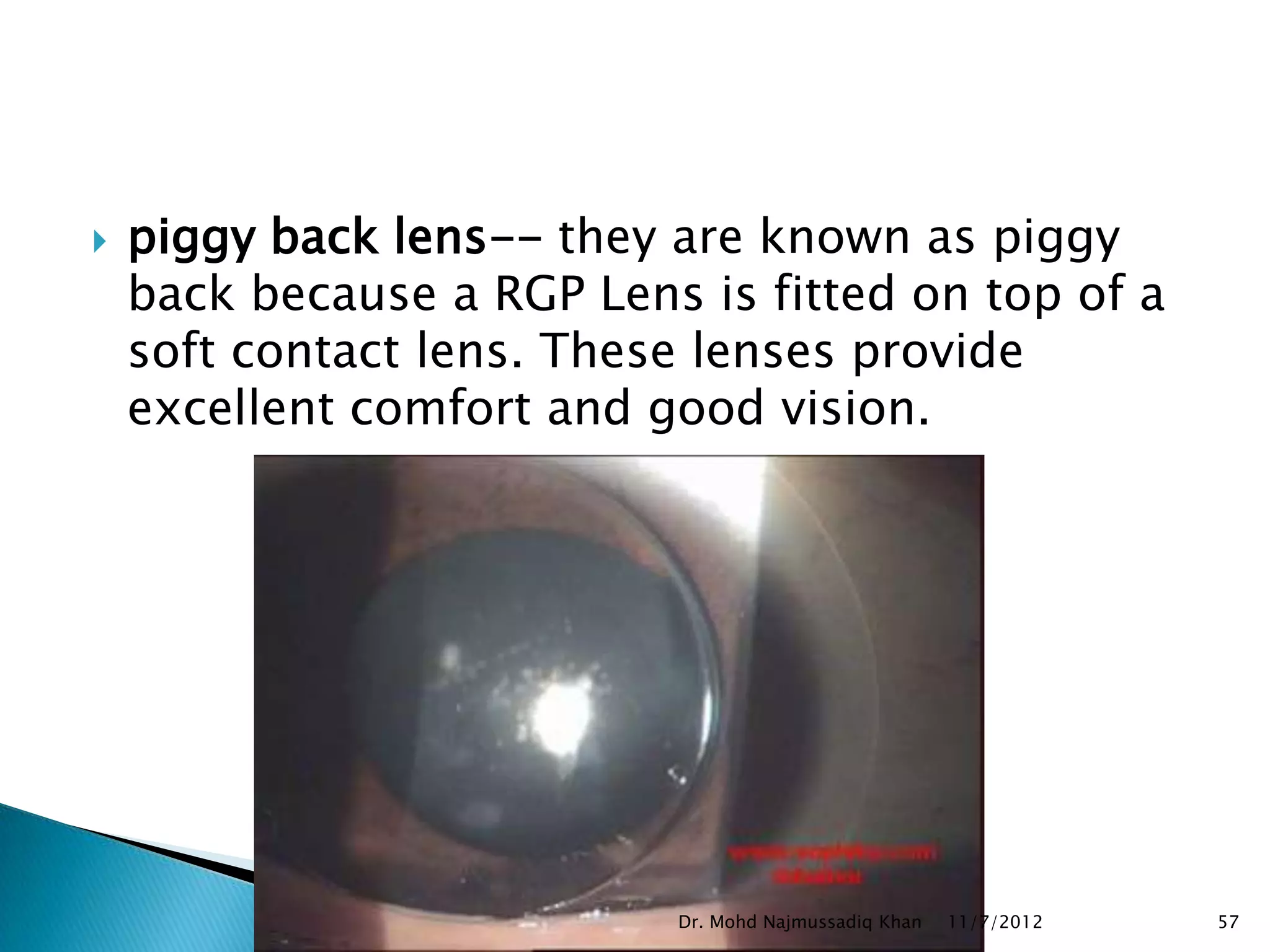    piggy back lens-- they are known as piggy
    back because a RGP Lens is fitted on top of a
    soft contact lens. These lenses provide
    excellent comfort and good vision.




                           Dr. Mohd Najmussadiq Khan   11/7/2012   57
 
