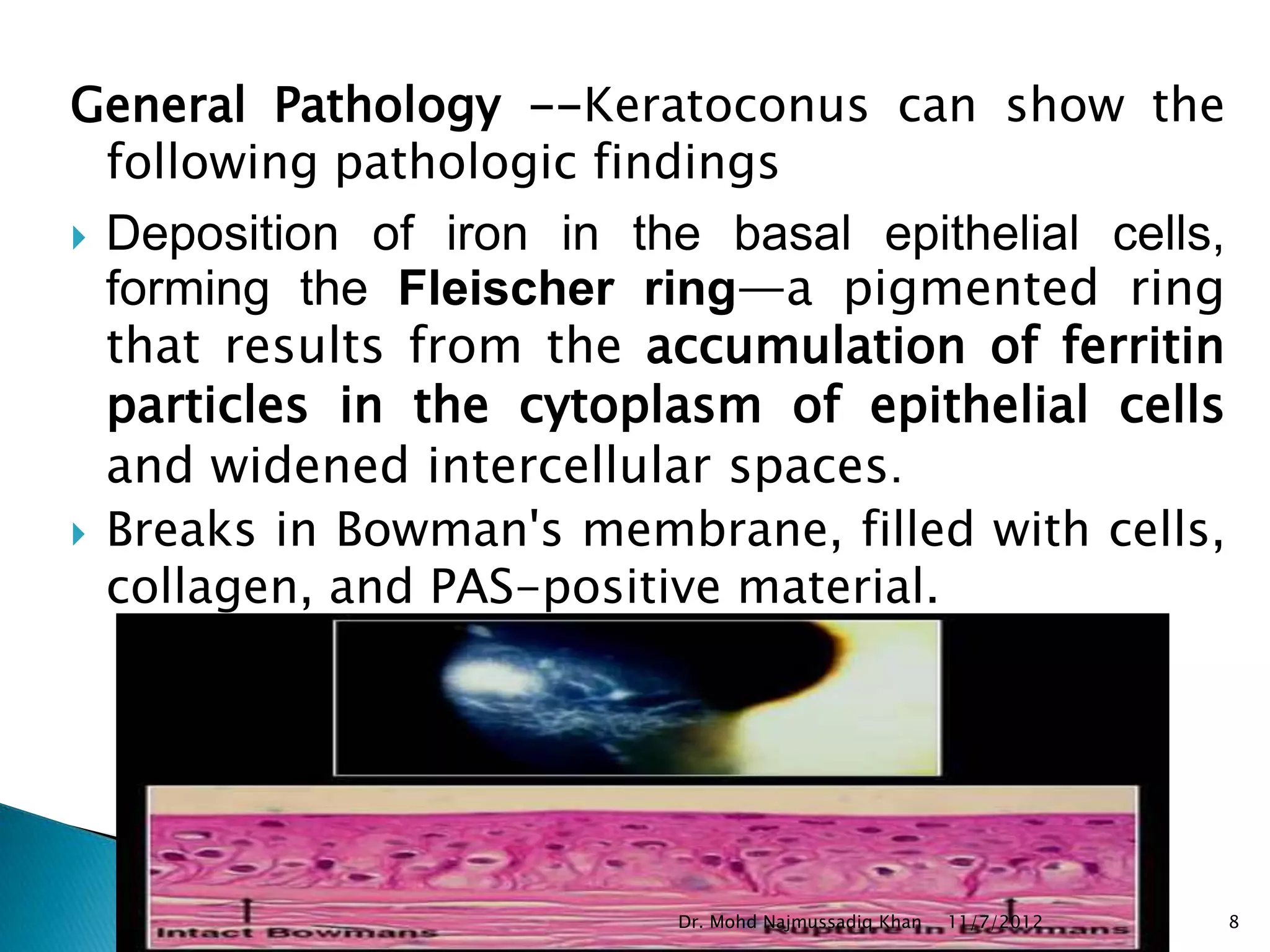 General Pathology --Keratoconus can show the
  following pathologic findings
 Deposition of iron in the basal epithelial cells,
  forming the Fleischer ring—a pigmented ring
  that results from the accumulation of ferritin
  particles in the cytoplasm of epithelial cells
  and widened intercellular spaces.
 Breaks in Bowman's membrane, filled with cells,
  collagen, and PAS-positive material.




                          Dr. Mohd Najmussadiq Khan   11/7/2012   8
 