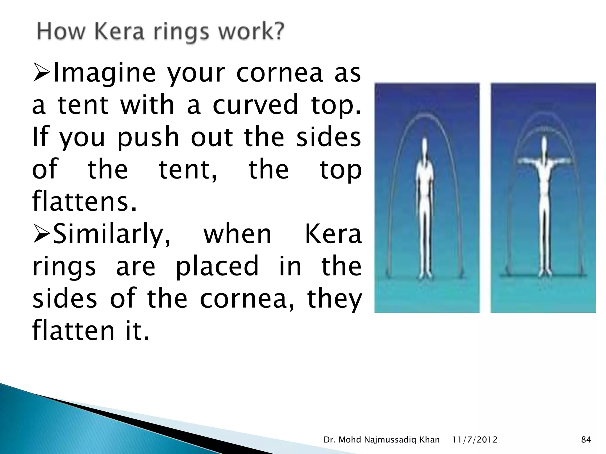 Imagine your cornea as
a tent with a curved top.
If you push out the sides
of the tent, the top
flattens.
Similarly, when Kera
rings are placed in the
sides of the cornea, they
flatten it.


                      Dr. Mohd Najmussadiq Khan   11/7/2012   84
 