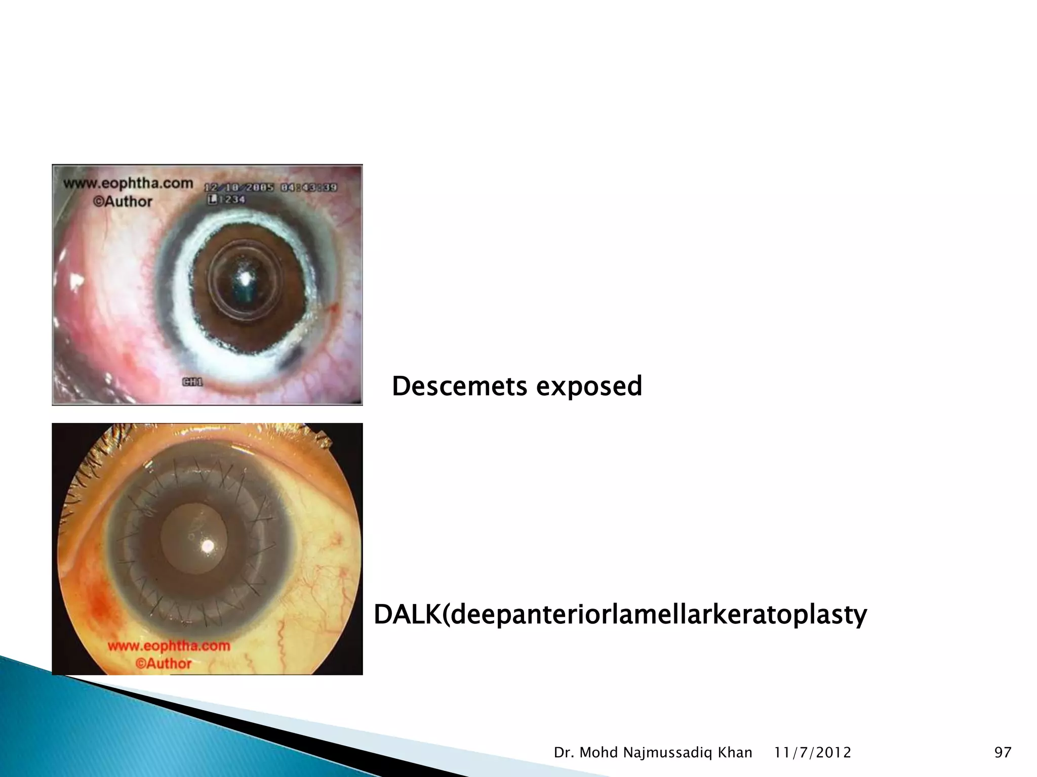 Descemets exposed




DALK(deepanteriorlamellarkeratoplasty




             Dr. Mohd Najmussadiq Khan   11/7/2012   97
 