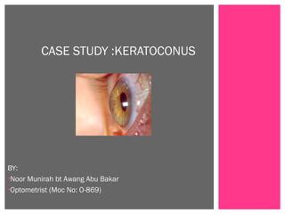 BY:
•Noor Munirah bt Awang Abu Bakar
•Optometrist (Moc No: O-869)
CASE STUDY :KERATOCONUS
 