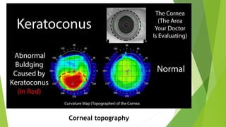 Keratoconus ,diagnosis and treatment | PPTX