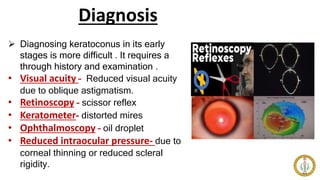 Diagnosis
 Diagnosing keratoconus in its early
stages is more difficult . It requires a
through history and examination .
• Visual acuity – Reduced visual acuity
due to oblique astigmatism.
• Retinoscopy – scissor reflex
• Keratometer- distorted mires
• Ophthalmoscopy – oil droplet
• Reduced intraocular pressure- due to
corneal thinning or reduced scleral
rigidity.
 