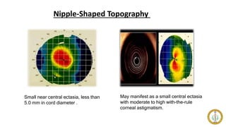 Nipple-Shaped Topography
Small near central ectasia, less than
5.0 mm in cord diameter .
May manifest as a small central ectasia
with moderate to high with-the-rule
corneal astigmatism.
 