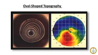 Oval-Shaped Topography
 