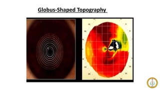 Globus-Shaped Topography
 