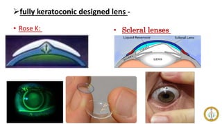 fully keratoconic designed lens -
• Rose K: • Scleral lenses
 