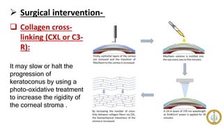 Surgical intervention-
 Collagen cross-
linking (CXL or C3-
R):
It may slow or halt the
progression of
keratoconus by using a
photo-oxidative treatment
to increase the rigidity of
the corneal stroma .
 