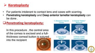  Keratoplasty
• For patients intolerant to contact lens and cases with scarring.
• Penetrating keratoplasty and Deep anterior lamellar keratoplasty can
be done .
Penetrating keratoplasty:
In this procedure , the central area
of the cornea is excised and a full-
thickness corneal button is sutured
into the recipient
 
