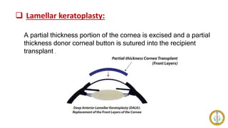  Lamellar keratoplasty:
A partial thickness portion of the cornea is excised and a partial
thickness donor corneal button is sutured into the recipient
transplant .
 