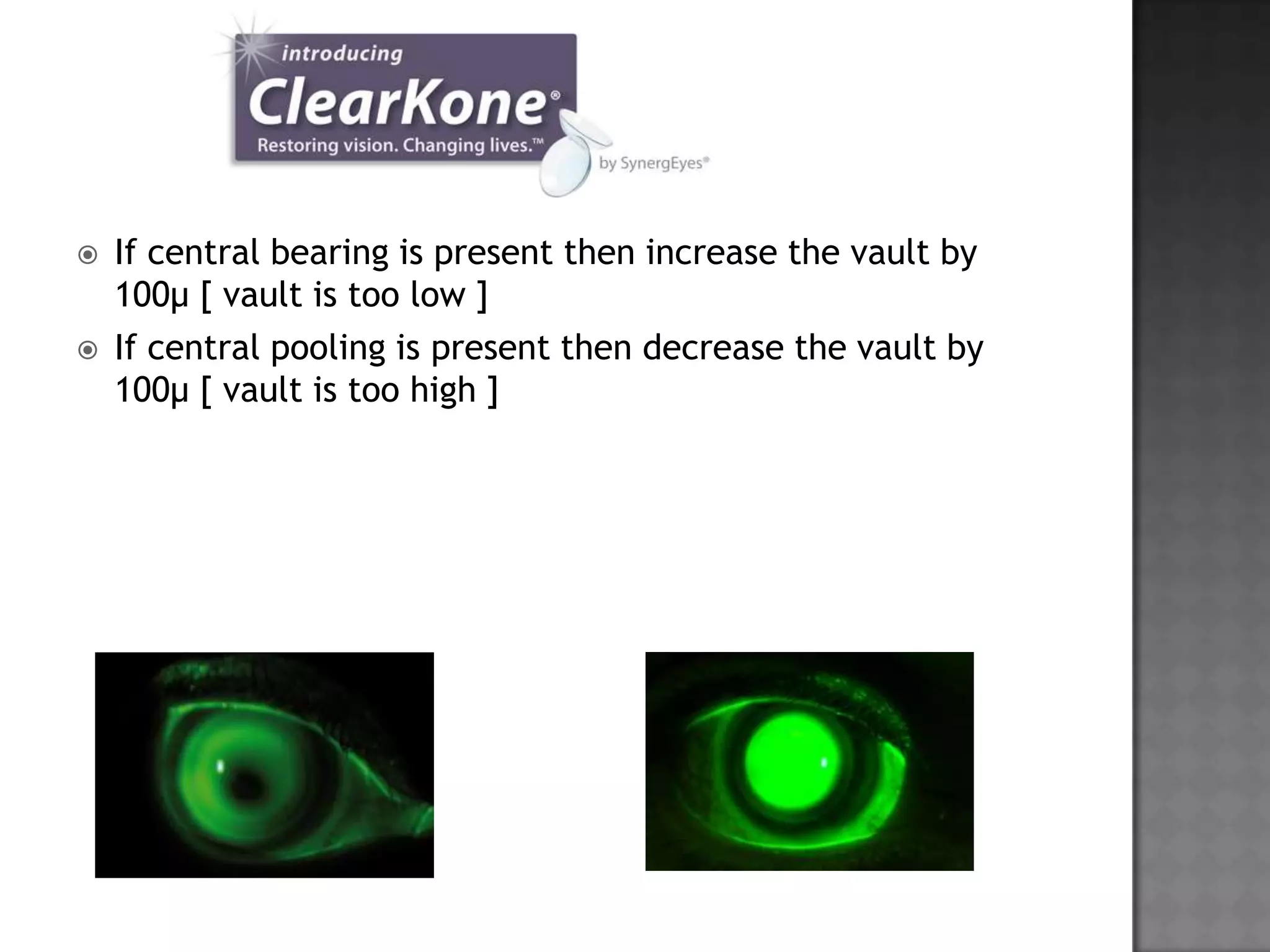  If central bearing is present then increase the vault by
100µ [ vault is too low ]
 If central pooling is present then decrease the vault by
100µ [ vault is too high ]
 