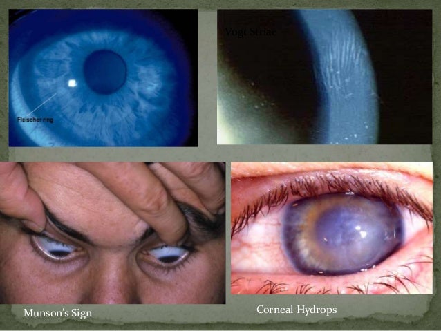 Keratoconus