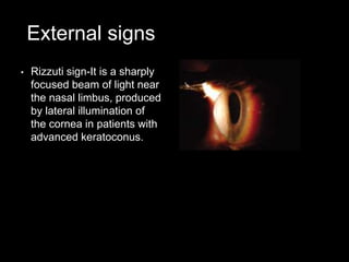 External signs
• Rizzuti sign-It is a sharply
focused beam of light near
the nasal limbus, produced
by lateral illumination of
the cornea in patients with
advanced keratoconus.
 