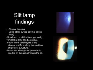 Slit lamp
findings
• Stromal thinning
• Vogts striae-(Deep stromal stress
lines)
-Small and brushlike lines, generally
vertical but they can be oblique.
-Found in the deep layers of the
stroma and form along the meridian
of greatest curvature.
-Disappear when gentle pressure is
exerted on the globe through the lid.
 