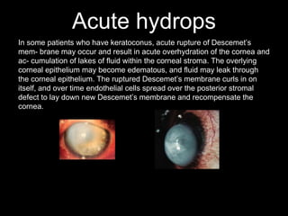 Acute hydrops
In some patients who have keratoconus, acute rupture of Descemet’s
mem- brane may occur and result in acute overhydration of the cornea and
ac- cumulation of lakes of fluid within the corneal stroma. The overlying
corneal epithelium may become edematous, and fluid may leak through
the corneal epithelium. The ruptured Descemet’s membrane curls in on
itself, and over time endothelial cells spread over the posterior stromal
defect to lay down new Descemet’s membrane and recompensate the
cornea.
 