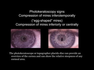 Photokeratoscopy signs
Compression of mires inferotemporally
(“egg-shaped” mires)
Compression of mires inferiorly or centrally
The photokeratoscope or topographer placido disc can provide an
overview of the cornea and can show the relative steepness of any
corneal area.
 