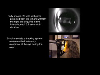 Forty images, 20 with slit beams
projected from the left and 20 from
the right, are acquired in two
intervals, each 0.7 seconds in
duration.
Simultaneously, a tracking system
measures the involuntary
movement of the eye during the
exam.
 