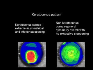 Keratoconus pattern
Keratoconus cornea-
extreme asymmetrical
and inferior steepening
Non keratoconus
cornea-general
symmetry overall with
no excessive steepening
 