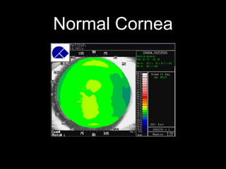 Normal Cornea
 