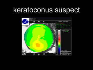 keratoconus suspect
 