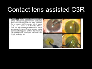 Contact lens assisted C3R
 