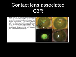Contact lens associated
C3R
 