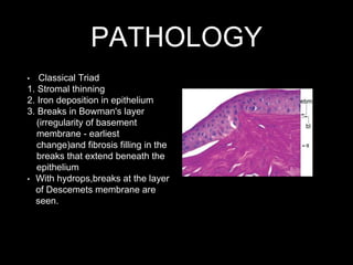 PATHOLOGY
• Classical Triad
1. Stromal thinning
2. Iron deposition in epithelium
3. Breaks in Bowman's layer
(irregularity of basement
membrane - earliest
change)and fibrosis filling in the
breaks that extend beneath the
epithelium
• With hydrops,breaks at the layer
of Descemets membrane are
seen.
 