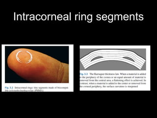 Intracorneal ring segments
 