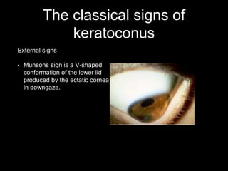 The classical signs of
keratoconus
External signs
• Munsons sign is a V-shaped
conformation of the lower lid
produced by the ectatic cornea
in downgaze.
 