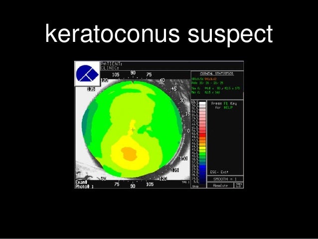 Keratoconus